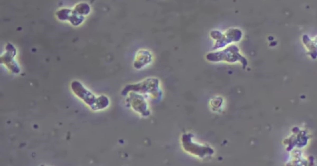 Teksašanka ispirala sinuse vodom iz slavine, umrla od amebe koja jede mozak