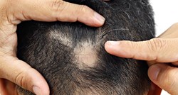 SAD odobrio novi lijek protiv alopecije: Može obnoviti do 80% kose na tjemenu