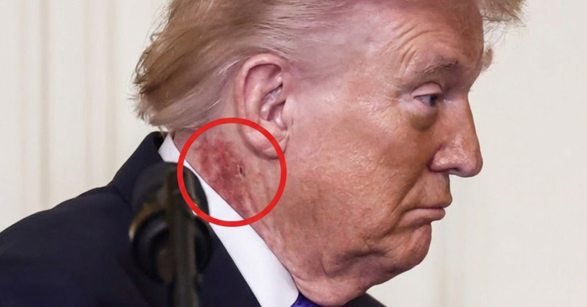 Što je to na Trumpovom vratu?