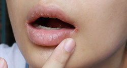 Ispucale usne nisu samo rezultat hladnoće i vjetra, evo neočekivanih uzroka