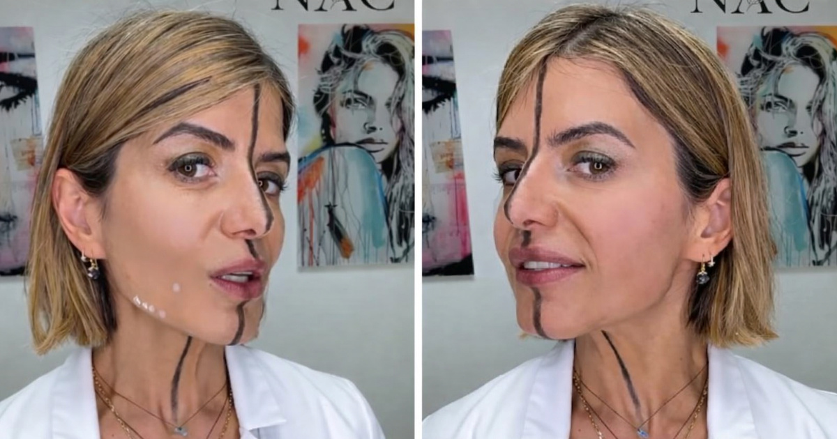 Liječnica ubrizgala botoks samo u jednu polovicu lica da pokaže njegov učinak