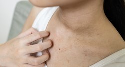 Simptom koji ukazuje na nedostatak cinka, a javlja se na koži