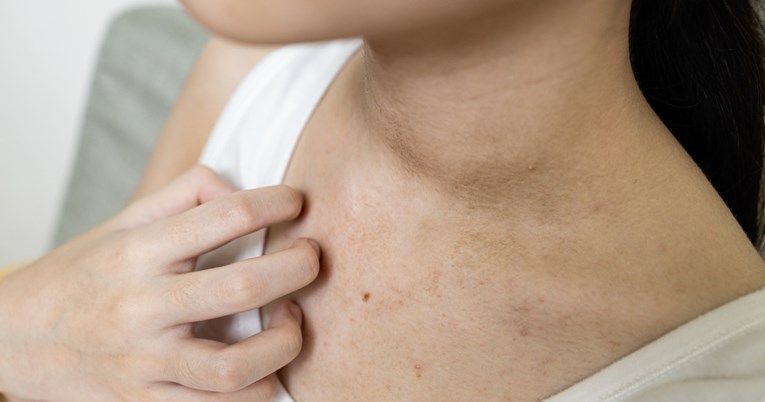 Simptom koji ukazuje na nedostatak cinka, a javlja se na koži