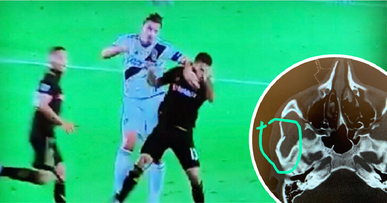 Ibrahimović ga u derbiju nokautirao laktom, a sada mora na operaciju lubanje