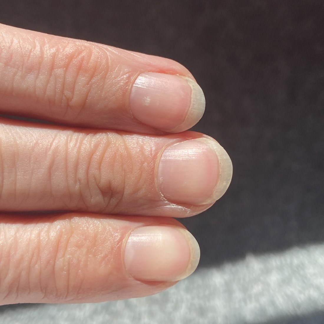 Simptom na noktima koji može biti rani znak zatajenja srca ili bolesti jetre