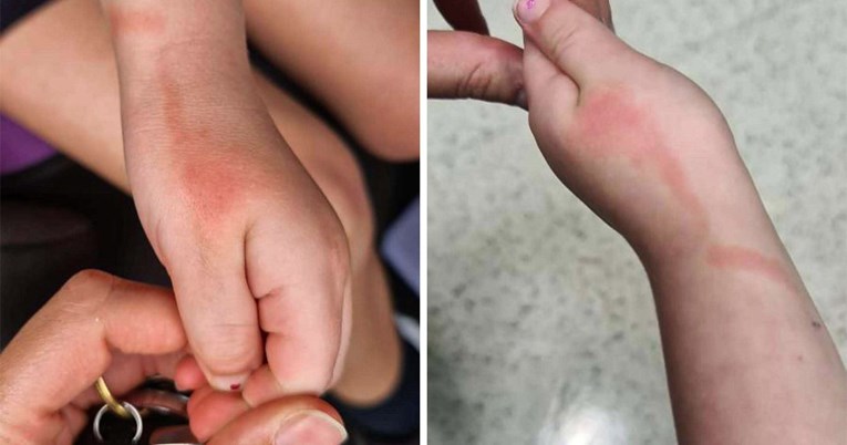 Crvena linija na koži djeteta može biti znak opasne infekcije