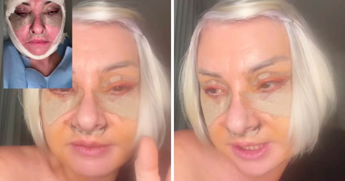 VIDEO Danijela Dvornik bila na faceliftingu: "Izgleda gore nego što jest"