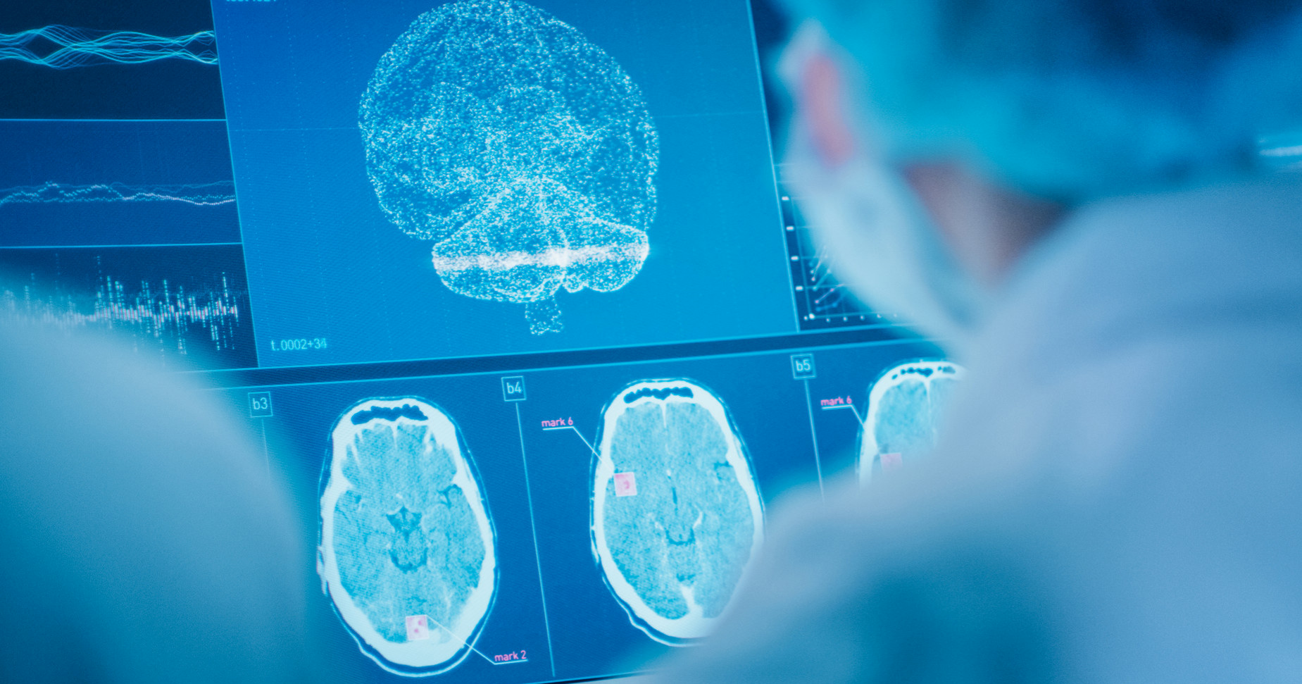 Nova metoda mogla bi pomoći u razumijevanju i liječenju Parkinsonove bolesti