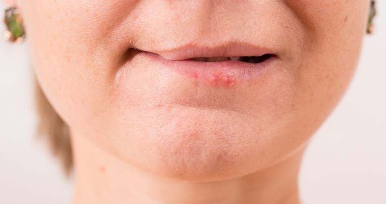 Možete li se zbog jednog poljupca zaraziti herpesom ili je to mit?
