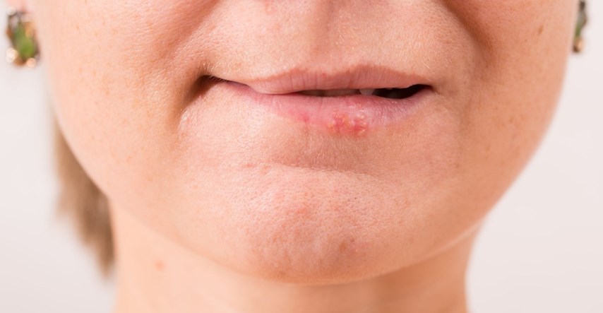Možete li se zbog jednog poljupca zaraziti herpesom ili je to mit?