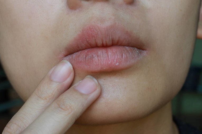 Balzam ne pomaže? Dermatolog objasnio zašto usne pucaju i kad treba liječniku