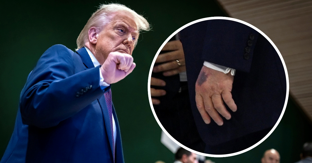 Trump objasnio modricu na ruci nakon što su nove fotografije privukle pažnju