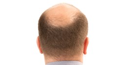 Šest načina da zaustavite gubitak kose