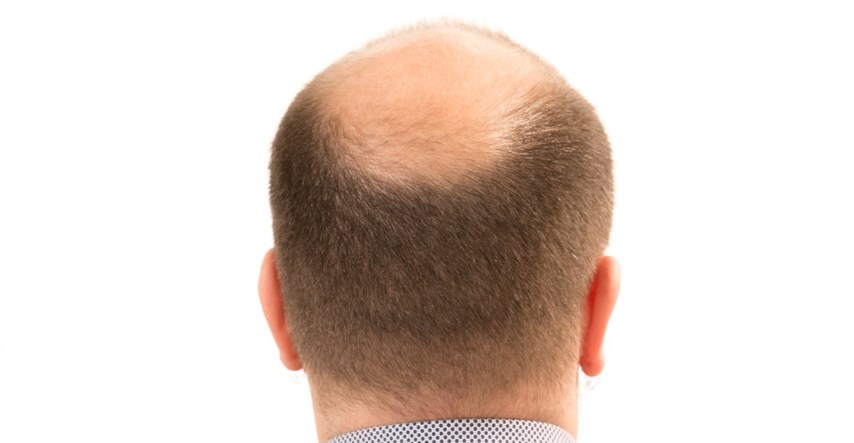 Šest načina da zaustavite gubitak kose