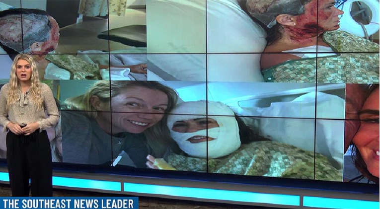 Brutalan napad kiselinom u parku: Žena iz Georgije bori se za život