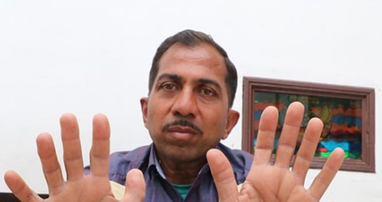 FOTO Čovjek s najviše prstiju na svijetu - ima ih čak 28