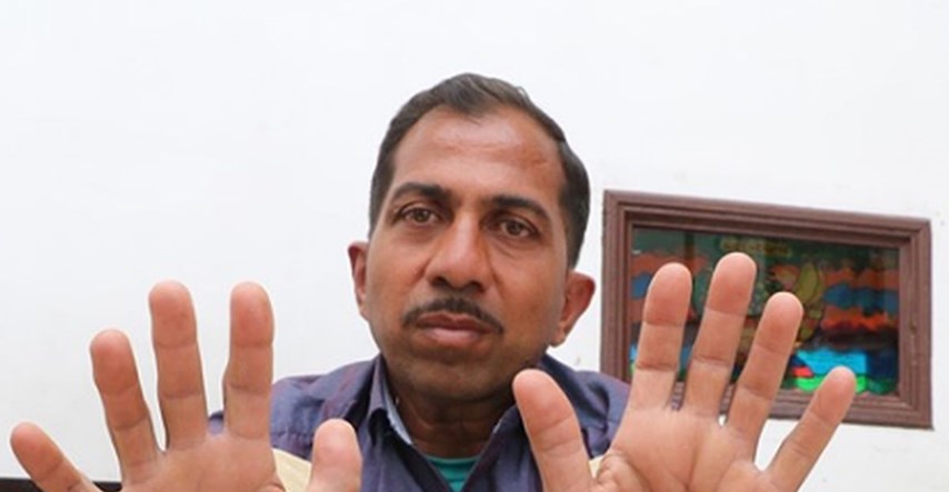 FOTO Čovjek s najviše prstiju na svijetu - ima ih čak 28