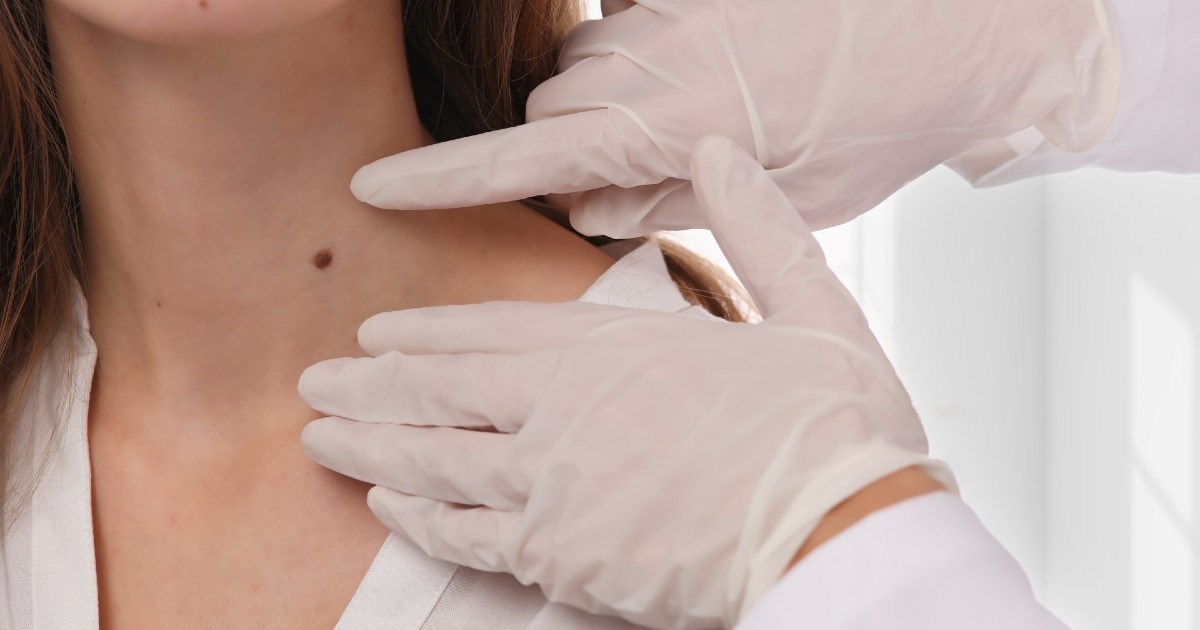 Onkolog podijelio kako provjeriti je li madež potencijalno opasan