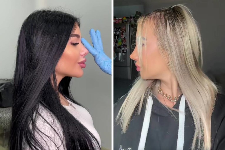 Trend "Barbie nosa" sve je popularniji, liječnici su zabrinuti: "Nema povratka"