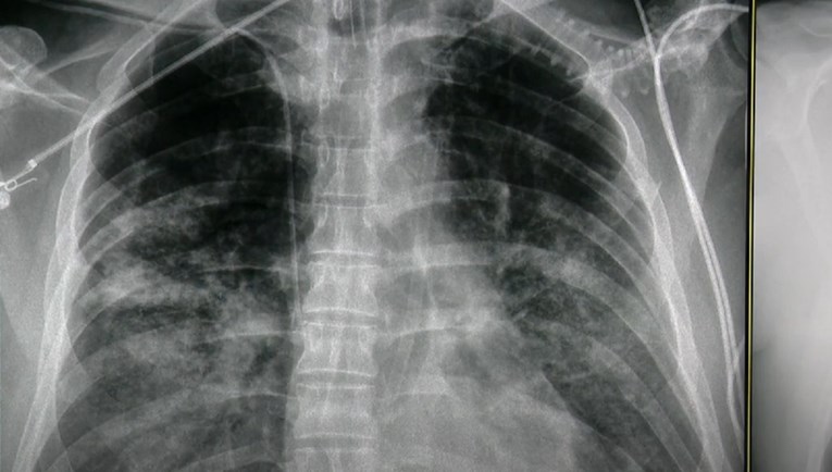 Ovo su pluća pacijenta s koronom iz Zagreba. Do zaraze nije imao kronične bolesti