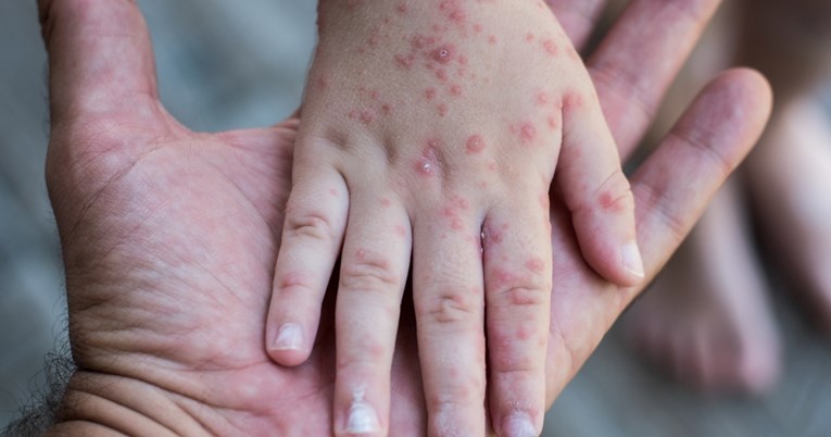 U Srbiji proglašena epidemija ospica, sve se poziva na cijepljenje