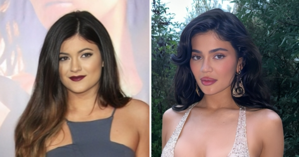 Slavni koji žale zbog plastičnih operacija podijelili iskustva i - ovo otvara oči