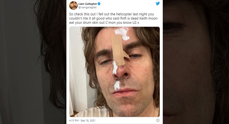 Liam Gallagher ispao iz helikoptera, fotografiju ozljeda objavio na Twitteru