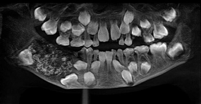 Stomatolozi iz usta 7-godišnjaka izvadili 526 zuba