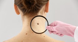 Dermatolozi upozoravaju na simptome raka kože koje većina ljudi ignorira