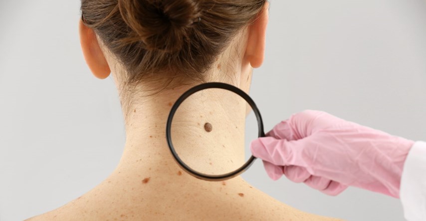 Dermatolozi upozoravaju na simptome raka kože koje većina ljudi ignorira