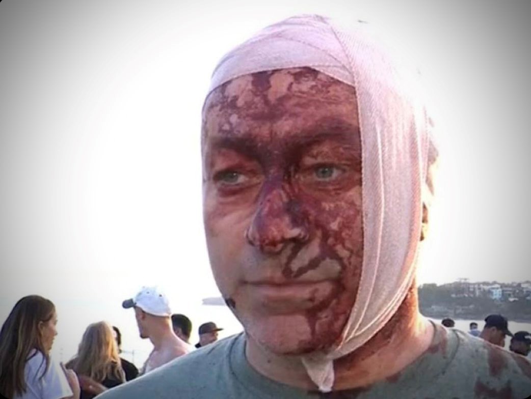 Vidio je zvjerstvo Hamasa na festivalu, a sad je ranjen u Australiji. "Puno je krvi"