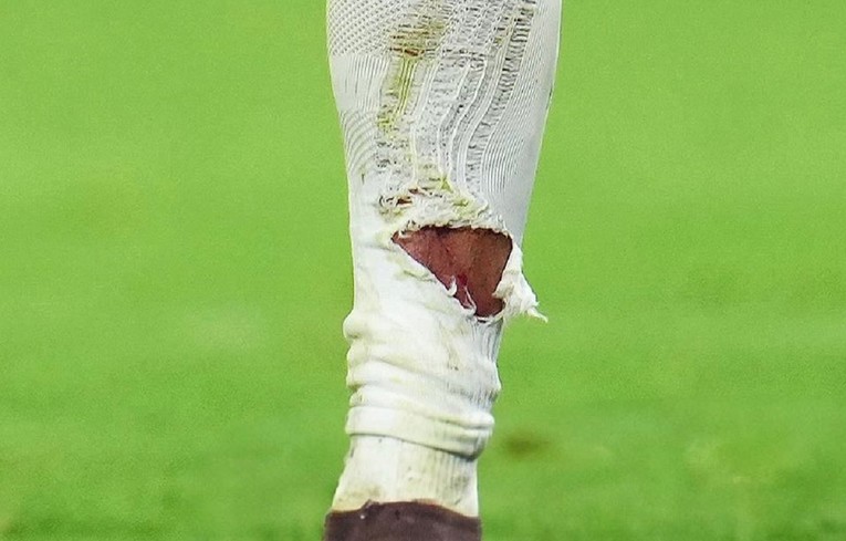 Viralna je slika Mbappeove noge. "Kako ovo nije za crveni karton Tahu?"