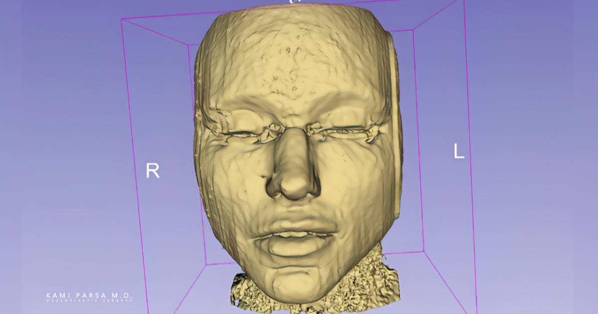 Kirurg otkrio što se događa s filerima u licu tijekom vremena