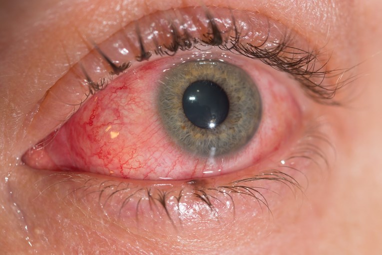 Osijekom se širi opasna zarazna bolest oka