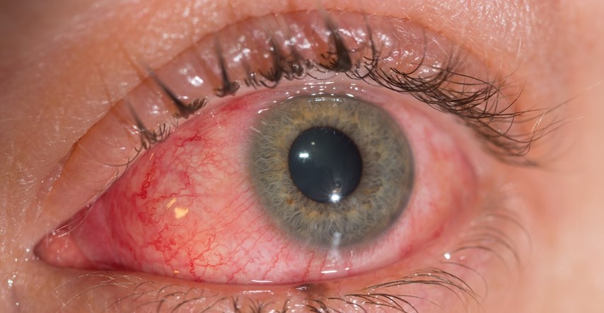 Osijekom se širi opasna zarazna bolest oka
