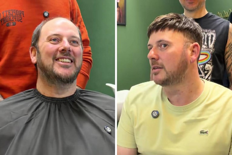 Nakon tretmana umetanja kose pogledao se u ogledalo i zaplakao: "Bio sam ćelav 20 g."