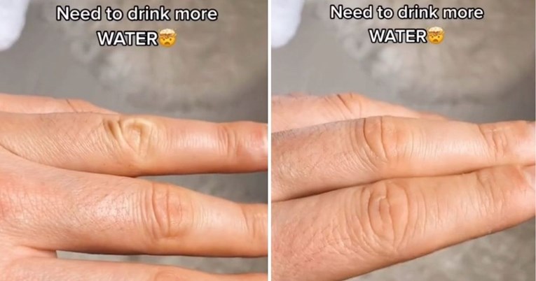 Liječnik otkrio neobičan trik koji će vam pokazati jeste li dehidrirali
