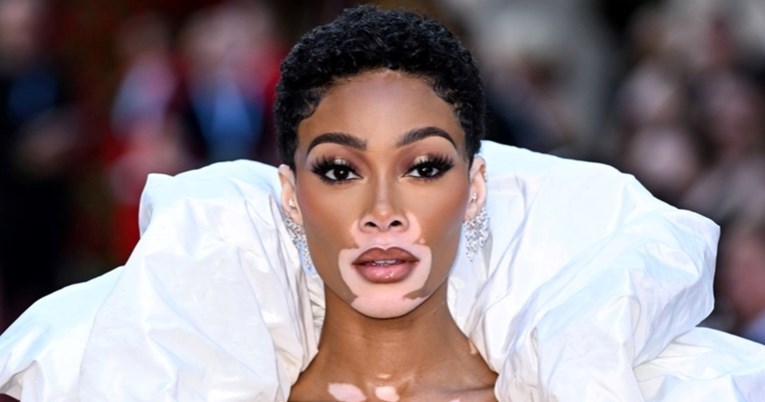 Manekenka s vitiligom neobičnom modnom kreacijom privukla poglede na zabavi Voguea