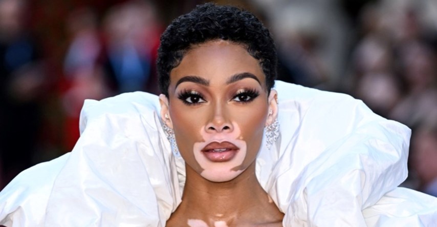 Manekenka s vitiligom neobičnom modnom kreacijom privukla poglede na zabavi Voguea