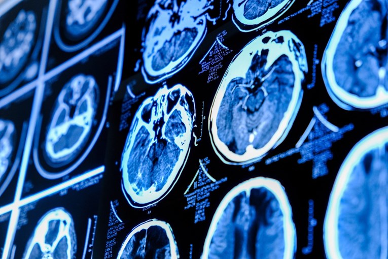 Otkriveno pet faza razvoja mozga. Ključne prekretnice su u 9., 32., 66. i 83. godini