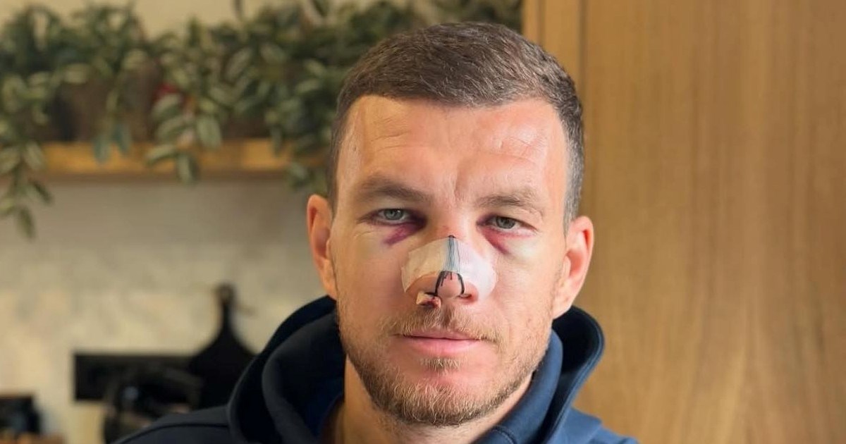 Pogledajte kako Džeko izgleda dva dana nakon što mu je kung-fu potezom slomljen nos