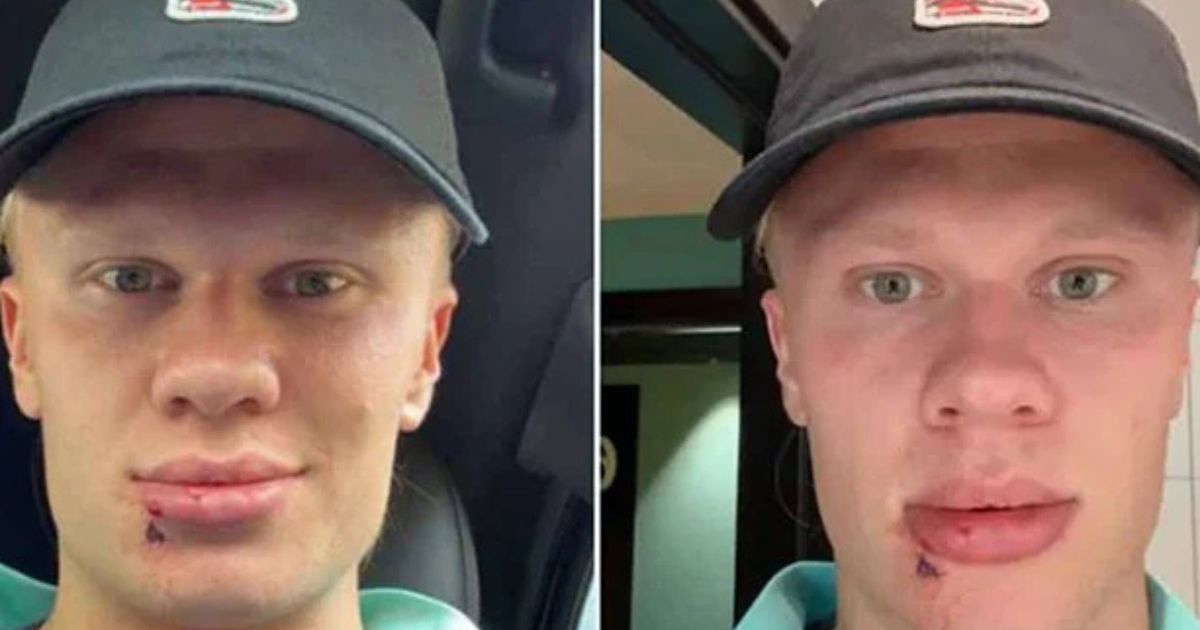 FOTO Bizarna ozljeda Haalanda. Udarila ga vrata od autobusa, završio na šivanju