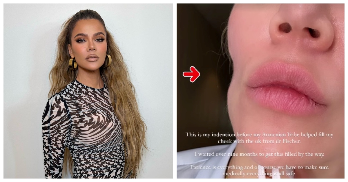 Khloe Kardashian pokazala udubinu na licu nakon operacije: "Imala sam rak kože"