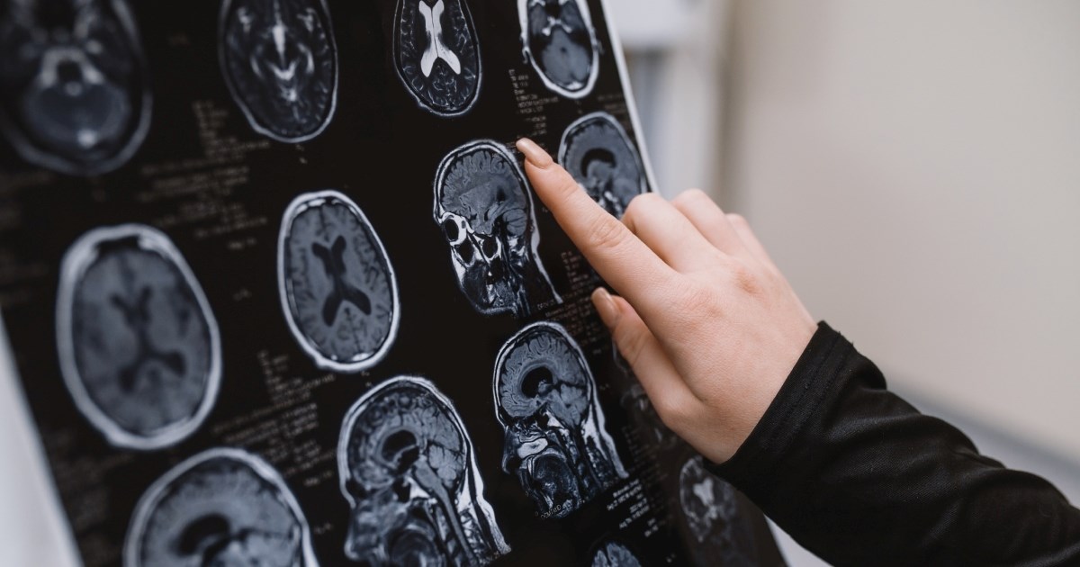 Kreatin i Alzheimer? Znanstvenici otkrivaju prve zanimljive rezultate