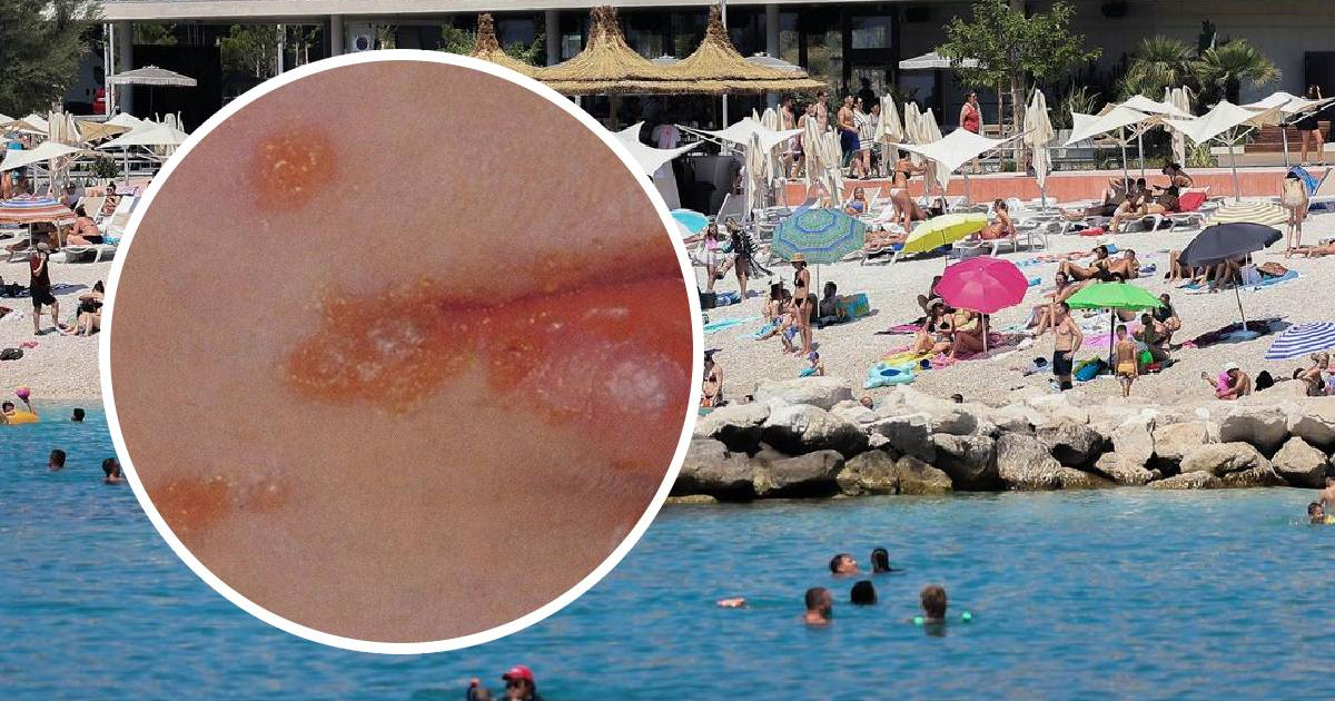 U Splitu se među djecom šire "slatke kraste". Ambulante pune djece
