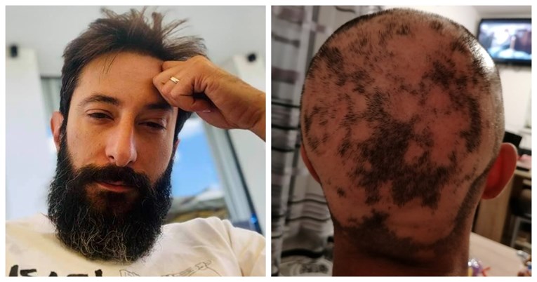 Asim Ugljen objavio fotku: "Ovo je alopecija. Ovako izgleda kad vas jako napadne"