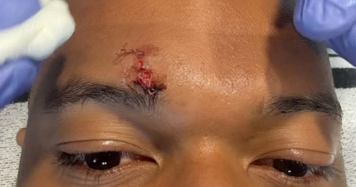 Mbappe objavio fotku. Pogledajte ozljedu za koju Real nije dobio penal