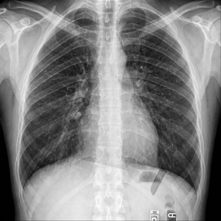 Nakon vađenja umnjaka počeo čudno štucati, rendgen otkrio uzrok