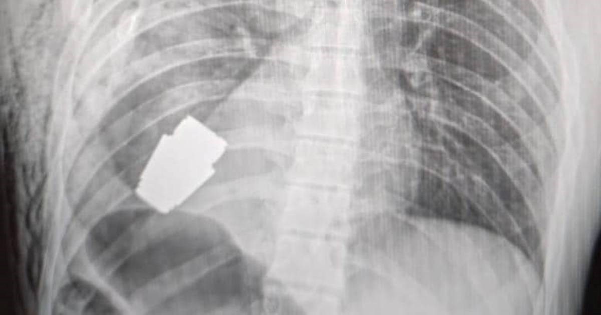 FOTO Liječnici iz tijela ukrajinskog vojnika izvadili nedetoniranu granatu