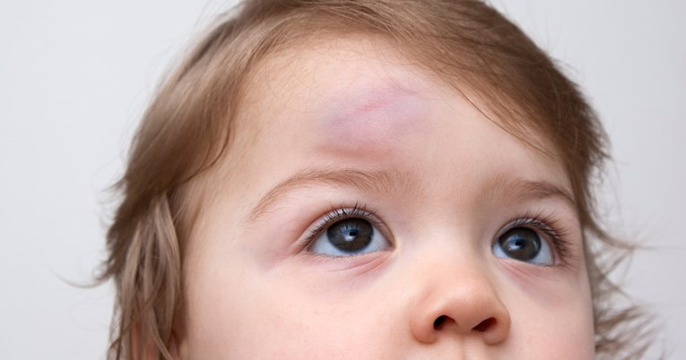 Bolničarka otkriva kako prepoznati da dijete treba hitnu pomoć nakon udarca u glavu